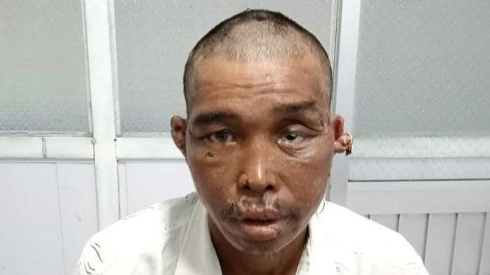 Kết quả giám định thương tích ông Trung là 48%