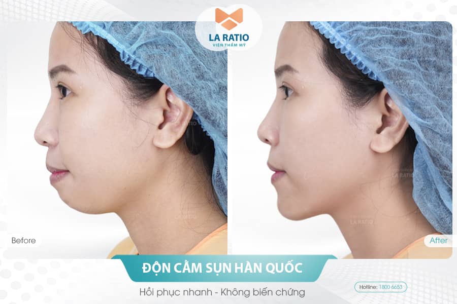 Xu hướng mewing có khắc phục được cằm lẹm không? - 4