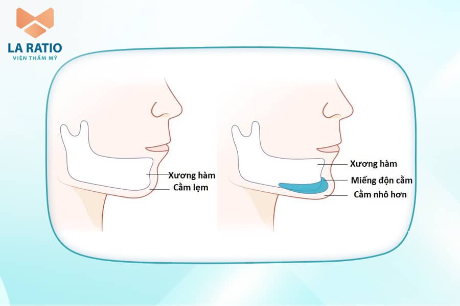 Xu hướng mewing có khắc phục được cằm lẹm không? - 3