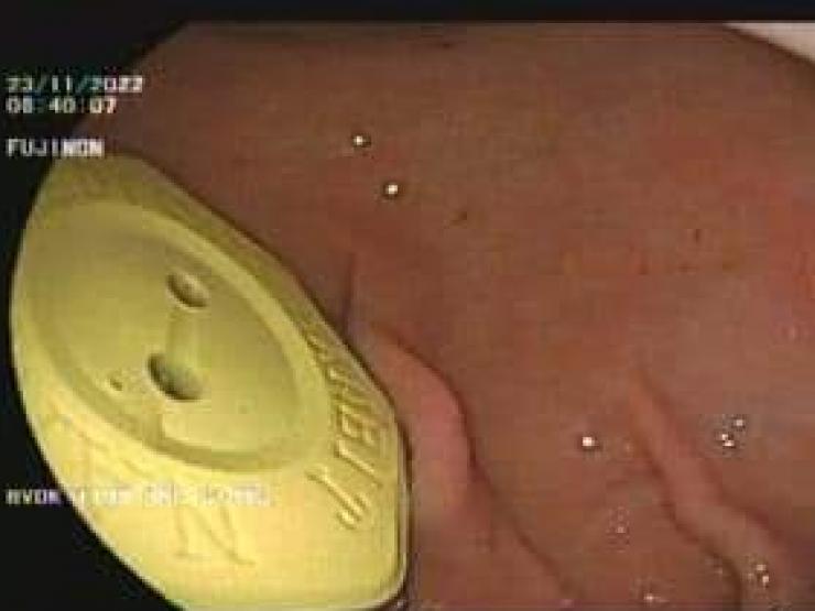 Sức khỏe đời sống - Ngậm viên đá “chữa bách bệnh” rồi ngủ quên, người phụ nữ nhận trái đắng