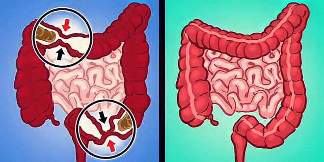 Sự khác biệt giữa người bị hội chứng ruột kích thích thể táo bón và người bình thường