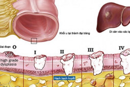 Ung thư đại trực tràng có chữa được không?