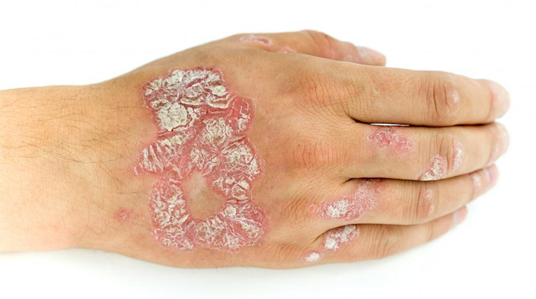 Triệu chứng viêm đỏ, tróc vảy trắng ở người bệnh vảy nến
