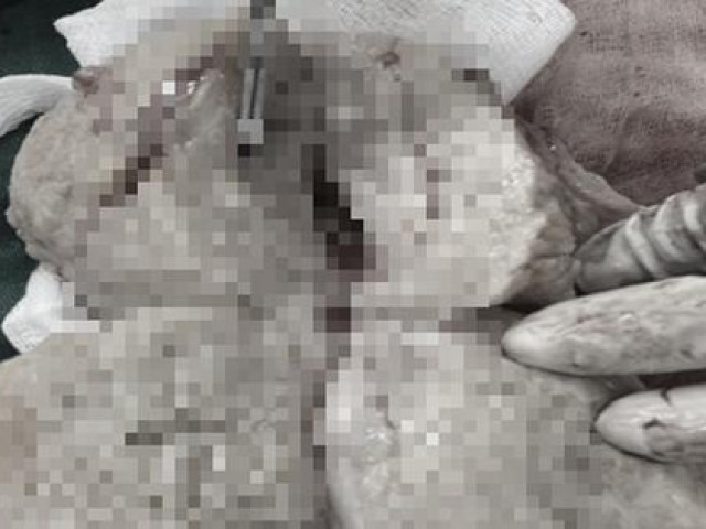 Sức khỏe đời sống - Kinh nguyệt kéo dài 20 ngày, bệnh nhân không ngờ mắc bệnh nặng