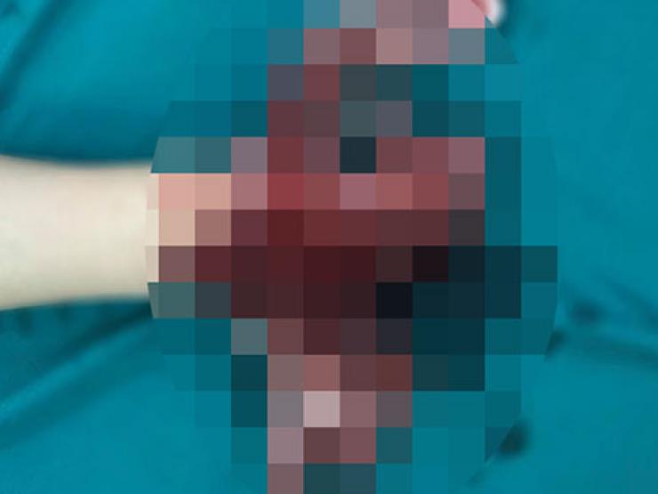 Sức khỏe đời sống - Điện thoại bất ngờ phát nổ, bé trai 14 tuổi bị dập nát tay