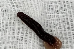 Sức khỏe đời sống - Người đàn ông uống nước suối bị con đỉa dài 5cm chui vào mũi