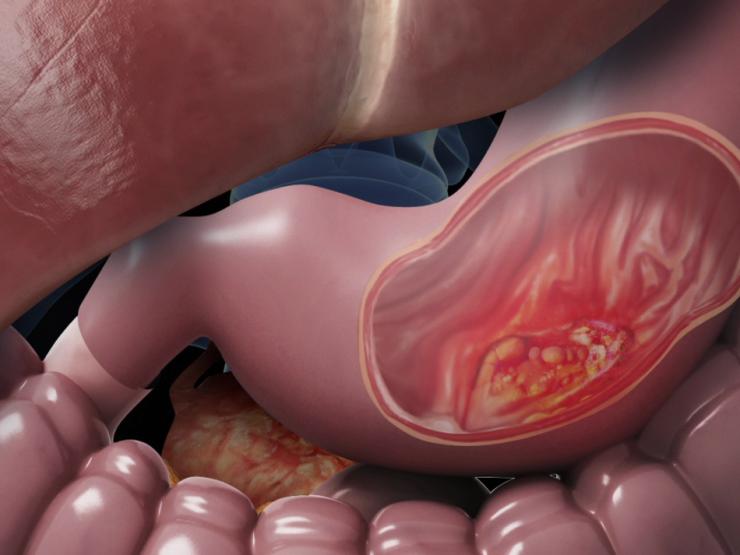 Sức khỏe đời sống - Chàng trai 26 tuổi mắc ung thư dạ dày giai đoạn cuối, nếu xuất hiện 5 "dấu hiệu" này cần nội soi ngay