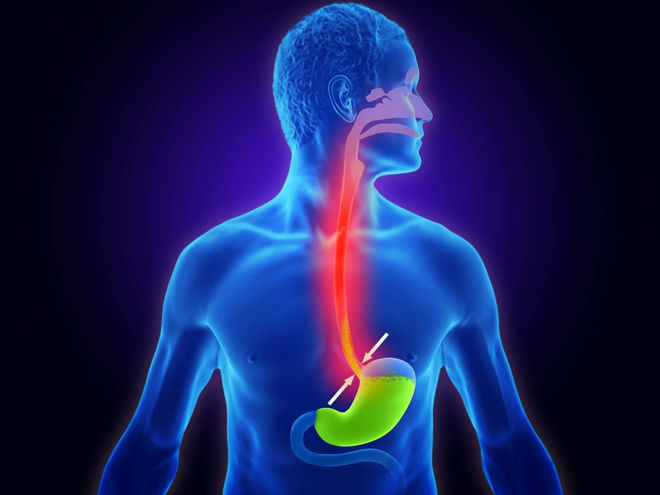 Nóng rát cổ họng, trắng lưỡi mãi không đỡ - Trào ngược dẫn lối, ung thư tiềm ẩn, bạn chớ coi thường! - 3