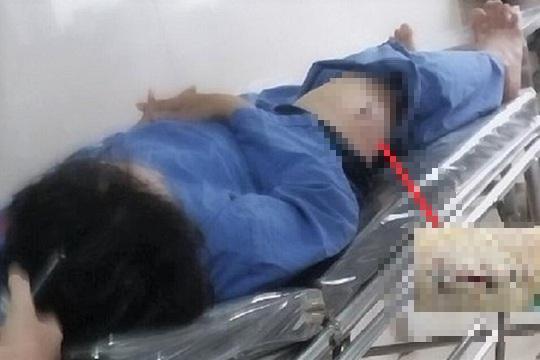 Vết thương ông G. bị kẻ xấu đâm vào đùi