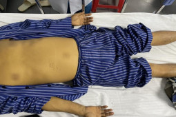 Sức khỏe đời sống - Người đàn ông 40 tuổi nguy kịch vì nhiễm vi khuẩn hiếm gặp