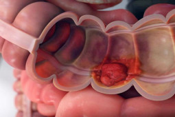 Sức khỏe đời sống - Trắc nghiệm: Muốn "né" ung thư trực tràng bạn cần phải biết những gì?