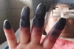 Sức khỏe đời sống - Đau nhức chân tay coi chừng bệnh lý nguy hiểm