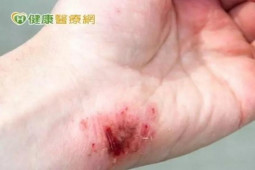 Sức khỏe đời sống - Người đàn ông suýt tử vong sau khi chế biến cá, đừng chủ quan với loại vết thương này