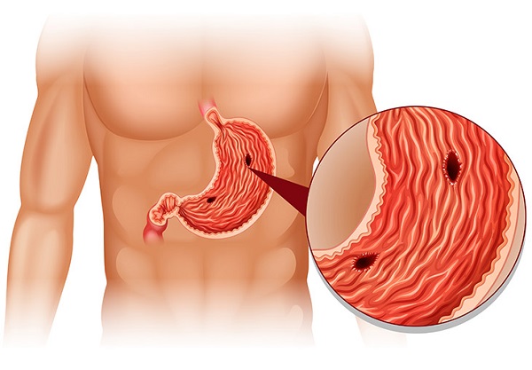 Nóng rát vùng thượng vị là triệu chứng của viêm loét dạ dày tá tràng (Ảnh minh họa)