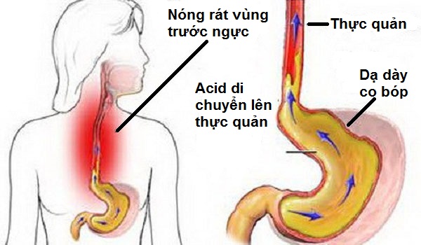 Viêm thực quản gây nóng rát vùng thượng vị (Ảnh minh họa)