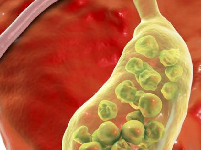 Sức khỏe đời sống - Chỉ đau lưng, người phụ nữ bất ngờ khi đi khám bác sĩ gắp ra 382 viên sỏi