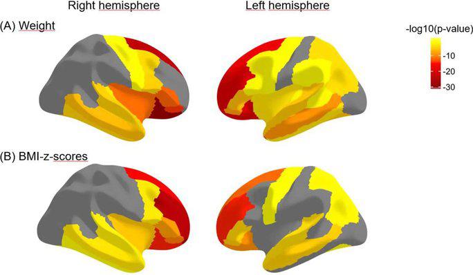 Độ dày vỏ não của các vùng trước trán tỉ lệ nghịch với cân nặng và chỉ số BMI, nghĩa là cân nặng và BMI cao hơn có liên quan đến độ dày vỏ não thấp hơn - Ảnh: RSNA/Simone Kaltenhauser