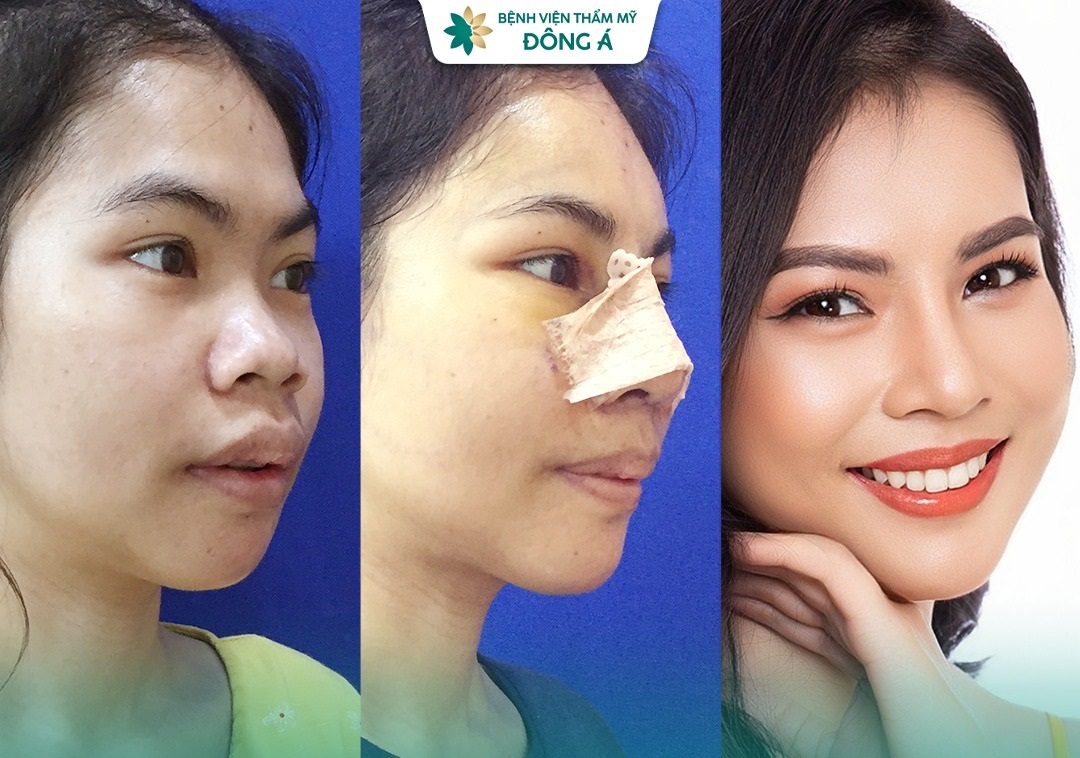 Hình ảnh khách hàng lựa chọn thay đổi dáng mũi để hợp phong thủy