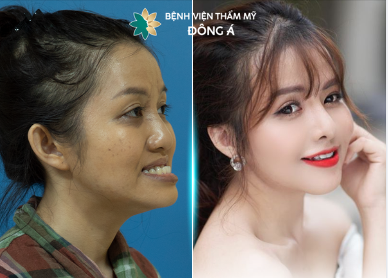 Xuân Vinh đã “lột xác” hoàn toàn sau thẩm mỹ để theo đuổi sự nghiệp âm nhạc