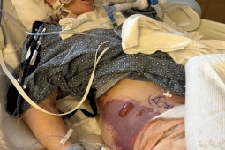 Sức khỏe đời sống - Cô gái 33 tuổi suýt chết vì đôi chân sưng to như "người khổng lồ"