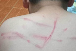 Tin tức trong ngày - Hoàn cảnh đáng thương của cậu bé lớp 4 bị cô giáo đánh “lằn lưng”