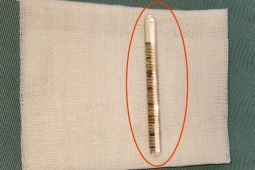 Sức khỏe đời sống - Kinh hãi nhiệt kế gãy trong niệu đạo của cậu bé 10 tuổi