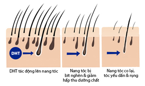 DHT là thủ phạm chính gây rụng tóc