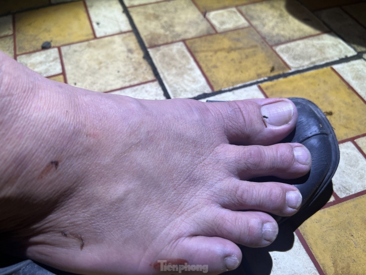 Một con muỗi truyền bệnh sốt rét đậu trên đầu ngón chân nhân viên y tế.