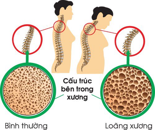 Xương yếu, biến dạng do suy giảm mật độ xương