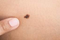 Sức khỏe đời sống - Dấu hiệu nhận biết nốt ruồi ác tính, mọi người nhất định phải biết