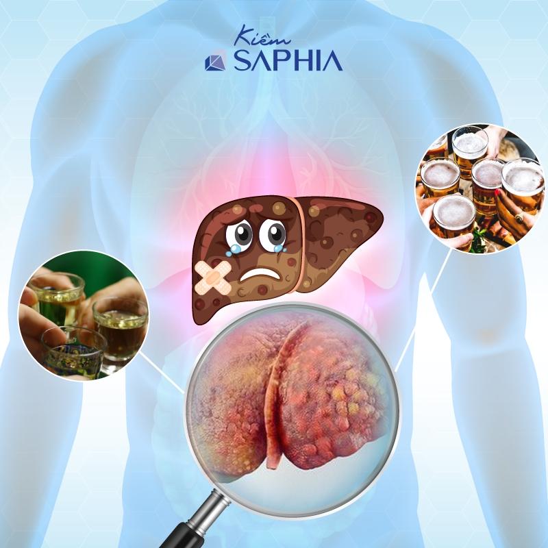 Bia rượu là nguyên nhân nguyên nhân hàng đầu gây bệnh gan