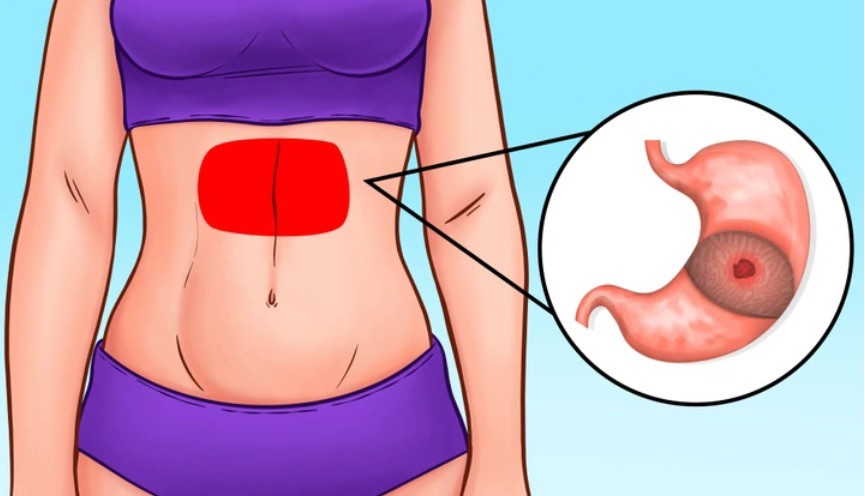 Vị trí đau bụng tiết lộ điều gì về sức khỏe của bạn? - 3