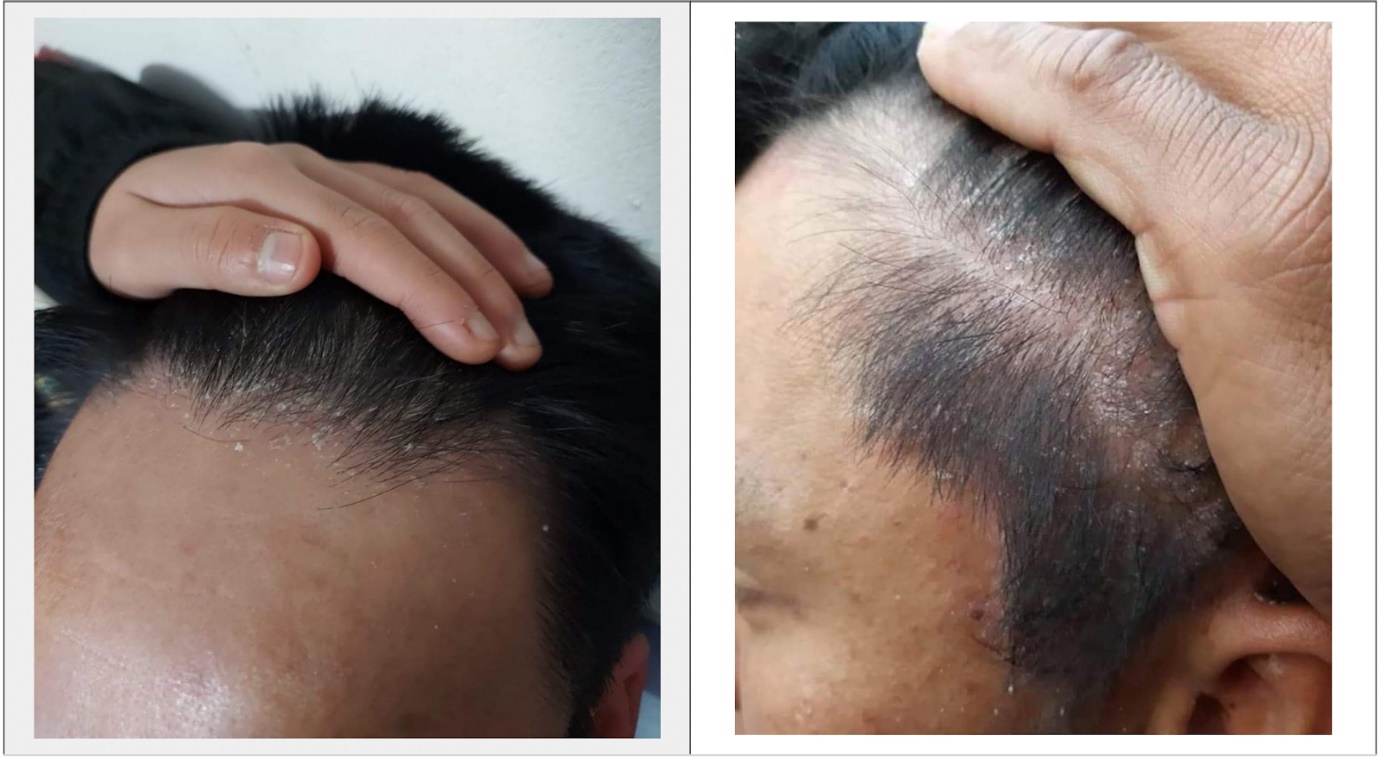 Nấm Pityrosporum là nguyên nhân chính gây gàu (Ảnh minh họa)