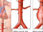 Sức khỏe đời sống - Căn bệnh khiến nghệ sĩ Bảo Anh 'Người đẹp Tây Đô' qua đời ở tuổi 68 mắc phải nguy hiểm thế nào?