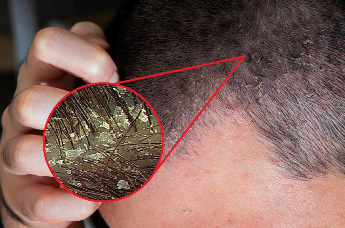 Sử dụng dầu gội không đúng cách khiến gàu nhiều hơn