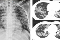 Sức khỏe đời sống - Tức ngực, khó thở, người đàn ông mắc bệnh hiếm gặp