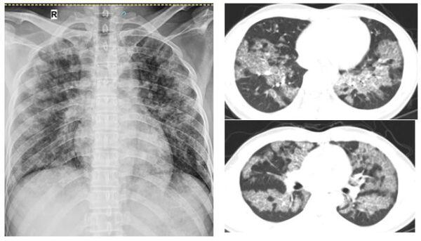 Hình ảnh tổn thương lan tỏa hai phổi của người bệnh trước khi rửa phổi.
