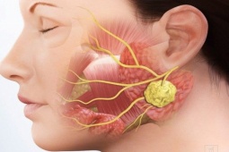 Sức khỏe đời sống - Thấy những dấu hiệu này nên nghĩ ngay đến ung thư tuyến nước bọt để kiểm tra sớm nhất