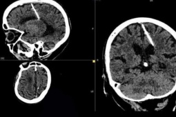 Kỳ lạ: Cụ bà sống khỏe mạnh dù có cây kim trong não suốt 80 năm