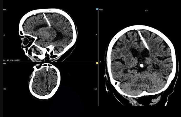 Kỳ lạ: Cụ bà sống khỏe mạnh dù có cây kim trong não suốt 80 năm - 1