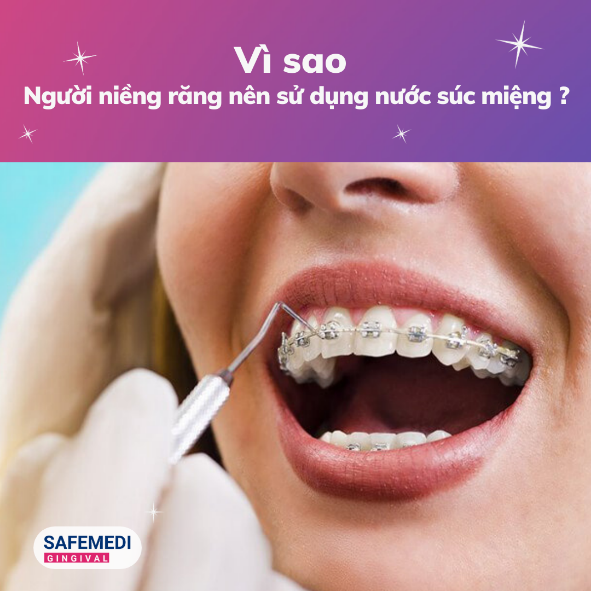 Vì sao người niềng răng nên sử dụng nước súc miệng
