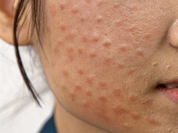 Biến chứng u hạt sau khi tiêm Meso không an toàn