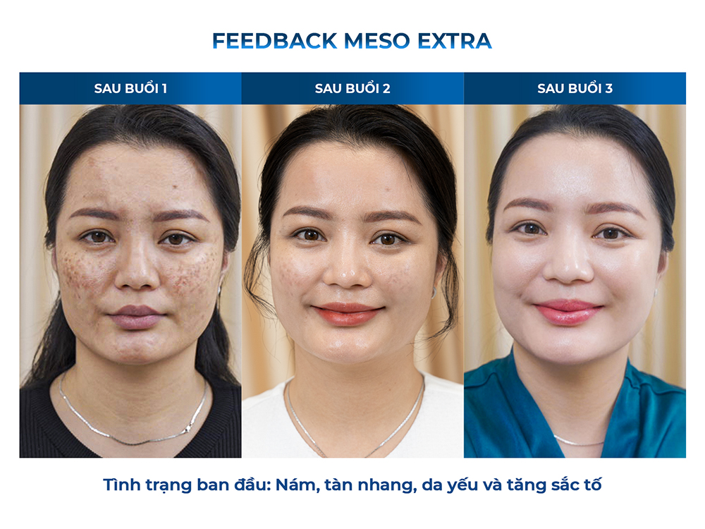 Khách hàng trước và sau khi kết thúc liệu trình meso Extra khắc phục tình trạng nám, tàn nhang.