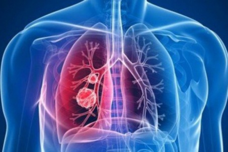 9 dấu hiệu cảnh báo ung thư phổi cần biết