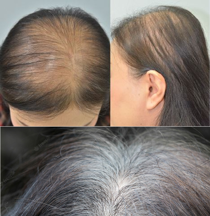 Rụng tóc, bạc tóc khiến bạn trông già đi