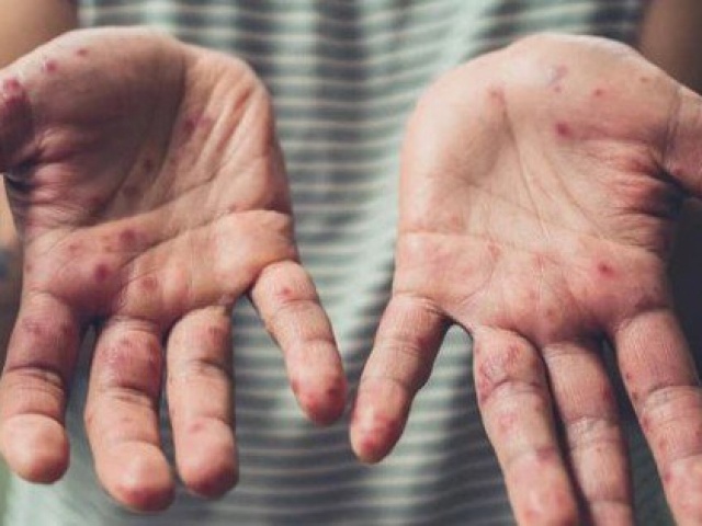 Sức khỏe đời sống - Chỉ trong 1 tuần TP HCM ghi nhận thêm 6 ca đậu mùa khỉ