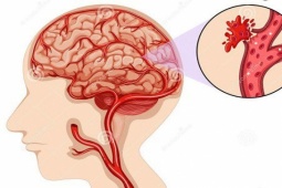 Sức khỏe đời sống - Người đàn ông 38 tuổi đột ngột bị xuất huyết não và liệt nửa người vì thói quen rất nhiều người mắc phải