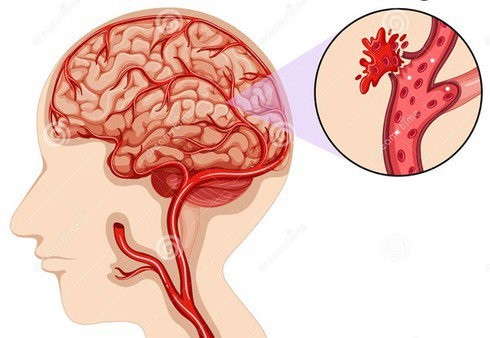 Người đàn ông 38 tuổi đột ngột bị xuất huyết não và liệt nửa người vì thói quen rất nhiều người mắc phải - 1