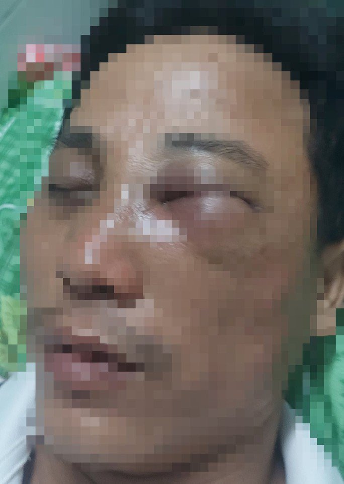 Thầy Thiều bị thương vùng mặt đang điều trị tại Bệnh viện 115