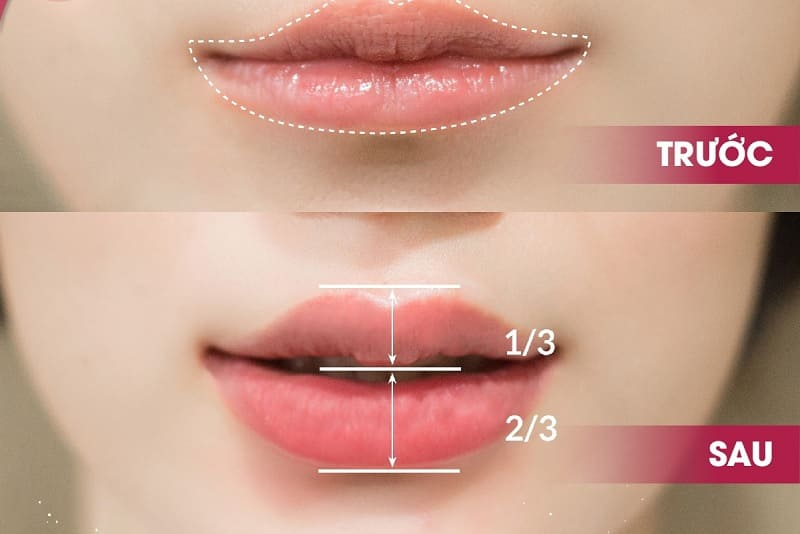 Tiêm filler môi tại Seoul Center với chi phí phù hợp